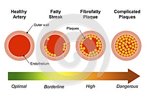 Different stages of atherosclerosis arterial disease