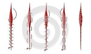 Different Surgical Stitches Isolated On White Background Vector Set