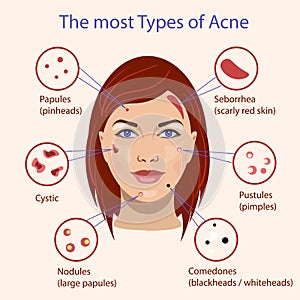 Different type of acne. Vector Illustration with skin problems.