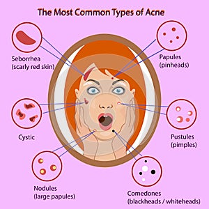 Different type of acne. Vector Illustration with skin problems. woman face isolated