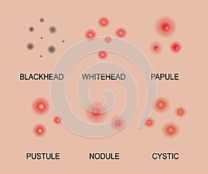 Different types of acne. Acne skin types. Blackheads, whiteheads, papules, pustules, cystic and nodular. Skincare