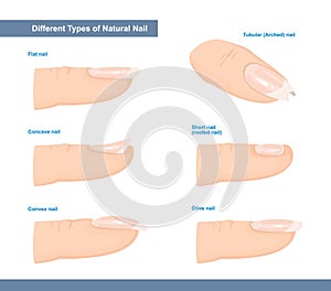 Different Types of Fingernail. Normal, Short, Roofed, Tubular, Arched, Flat, Convex and Concave Nails. Nail Extension Guide.