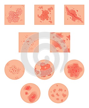 Different types of psoriasis vector set. Part of patients skin with dermatitis, inflammation, red rash and other skin