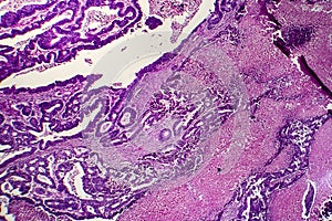 Differentiated intestinal adenocarcinoma, light micrograph