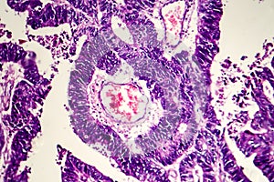 Differentiated intestinal adenocarcinoma, light micrograph