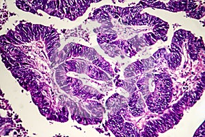 Differentiated intestinal adenocarcinoma, light micrograph