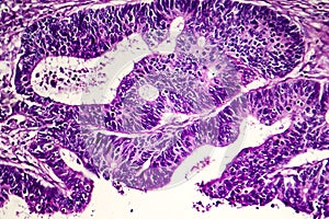 Differentiated intestinal adenocarcinoma, light micrograph