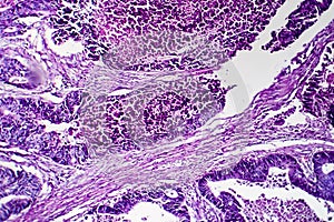 Differentiated intestinal adenocarcinoma, light micrograph