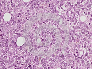 Diffuse large B cell lymphoma, Bone marrow.