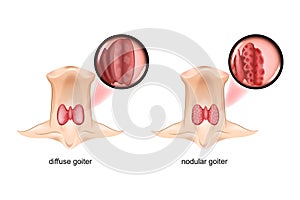 Diffuse and nodular goiter, the thyroid gland is a sectional view