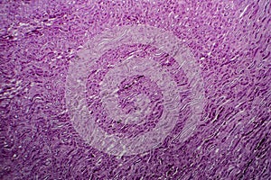 Diffuse proliferative glomerulonephritis