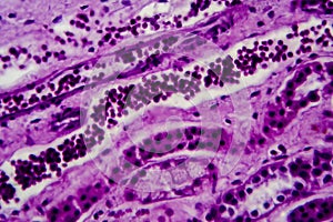 Diffuse proliferative glomerulonephritis