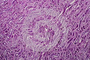 Diffuse proliferative glomerulonephritis