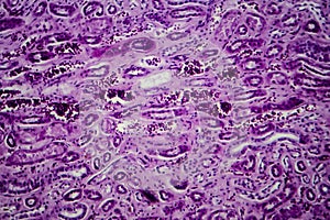 Diffuse proliferative glomerulonephritis