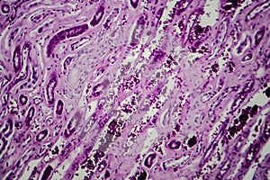 Diffuse proliferative glomerulonephritis