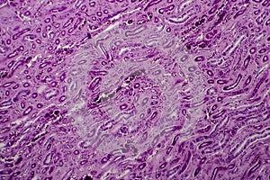Diffuse proliferative glomerulonephritis