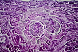 Diffuse proliferative glomerulonephritis
