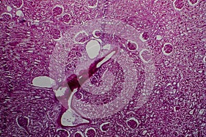Diffuse sclerosing glomerulonephritis