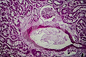 Diffuse sclerosing glomerulonephritis photo