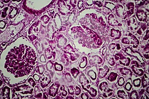Diffuse sclerosing glomerulonephritis