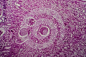 Diffuse sclerosing glomerulonephritis