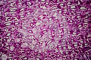 Diffuse sclerosing glomerulonephritis photo