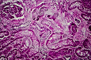 Diffuse sclerosing glomerulonephritis