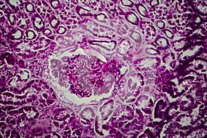 Diffuse sclerosing glomerulonephritis photo