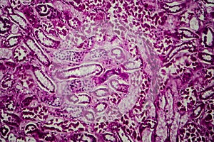 Diffuse sclerosing glomerulonephritis photo