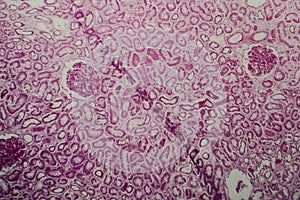 Diffuse sclerosing glomerulonephritis