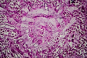 Diffuse sclerosing glomerulonephritis