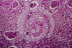 Diffuse sclerosing glomerulonephritis