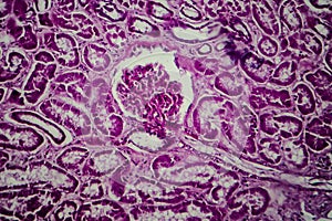 Diffuse sclerosing glomerulonephritis