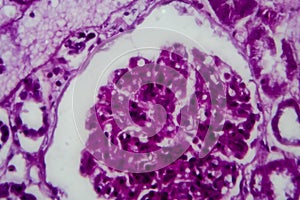 Diffuse sclerosing glomerulonephritis