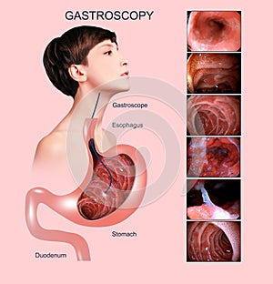 Digestive endoscopy or gastroscopy. Performing a gastroscopy procedure. Diagnostics of gastric diseases. Stomach health. photo