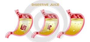 Digestive juice  / enzyme / stomach