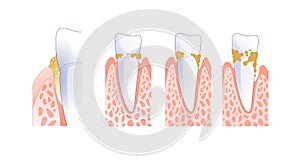 Digital illustration of teeth and gums with tartar.