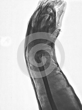 Digital radiography of arm and hand. X ray of left side