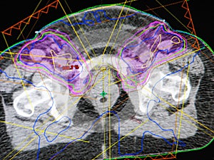 Digital scan of pelvis