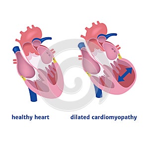 dilated cardiomyopathy.
