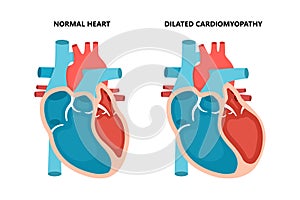 Dilated cardiomyopathy with cross-section view. Human heart muscle diseases. Cardiology concept.