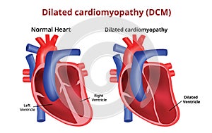 Dilated cardiomyopathy, Heart disease, Vector image