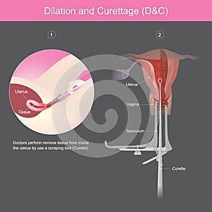 Dilation and Curettage.