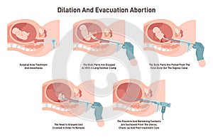 Dilation and evacuation abortion. Gynecology surgery. Embryo