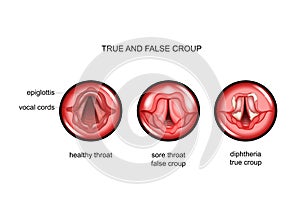 Diphtheria. true and false croup