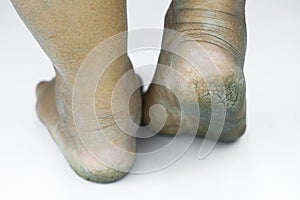 Dirty foot or cracked heels isolate on white background, medical or feet health of the people, medical center for heels or feet