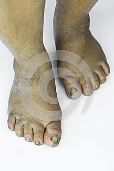 Dirty foot or cracked heels isolate on white background, medical or feet health of the people, medical center for heels or feet