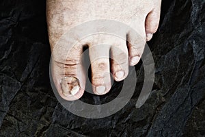 Dirty old diseased bare foot close-up