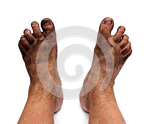 Dirty unhygienic foots