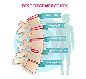Disc degeneration flat illustration vector diagram with condition exampes - bulging, hernoated, degenerative and thinning disc. Ed